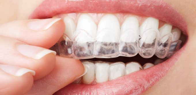 pessoa a colocar aparelho invisalign